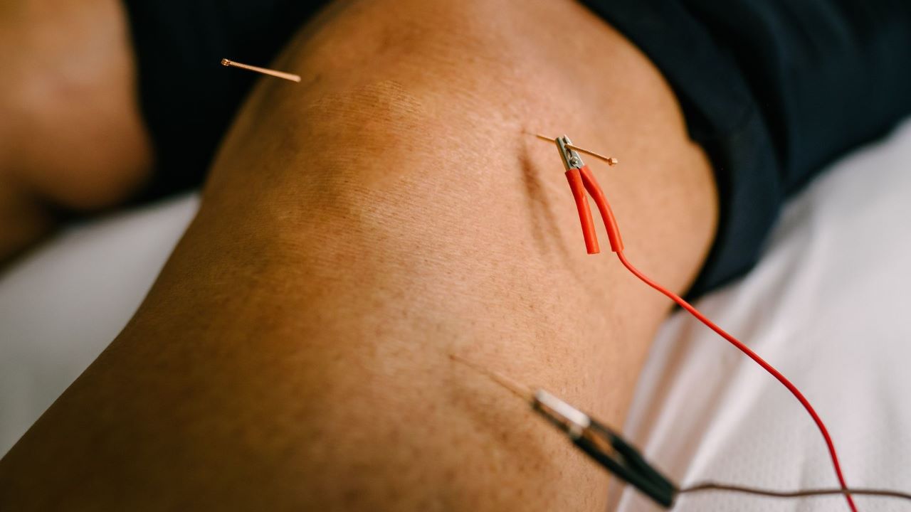 Close up of electro acupuncture using needles attached to cables using metal clips.
